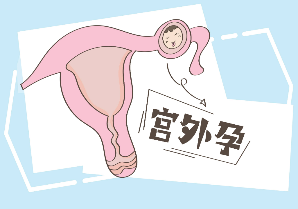 宫外孕